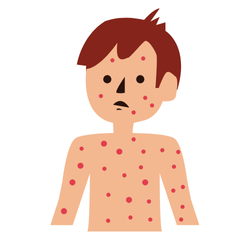 A child with measles