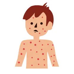 A boy full of red spots in his body